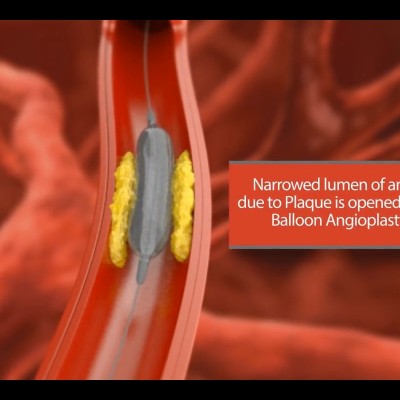 انیمیشن آنژیوپلاستی